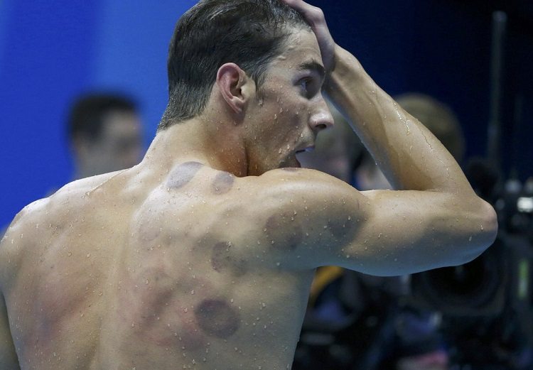 MIchael Phelps de costas, sem camisas, com as marcas das ventosas a mostra